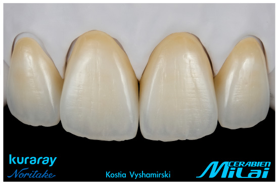 Nowoczesne metody estetycznego mikrowarstwowania prac z tlenku cyrkonu.
